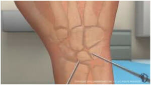 Wrist Surgery at St. George Surgical Center