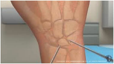 Wrist Surgery at St. George Surgical Center