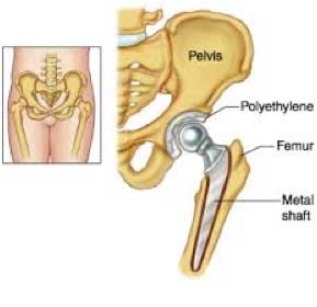 Hip Replacement Xray thumbnail