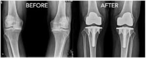 Knee replacement in St. George, Utah