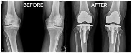 Knee replacement in St. George, Utah