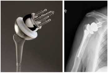 shoulder reverse replacement