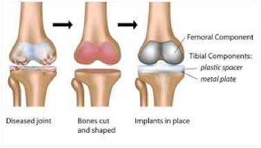 Femor Tibia Surgery St. George, Utah