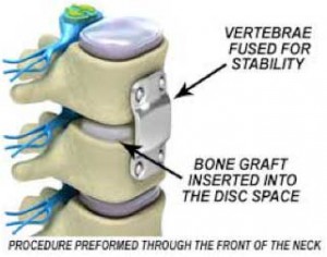 cervical-discectomy