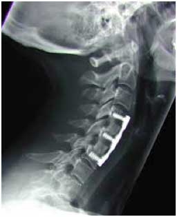 cervical surgery in Utah
