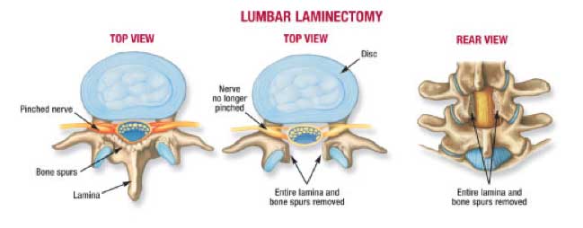 laminectomy