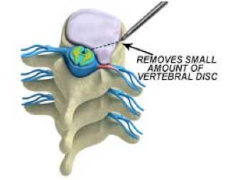 Vertebral disc removal