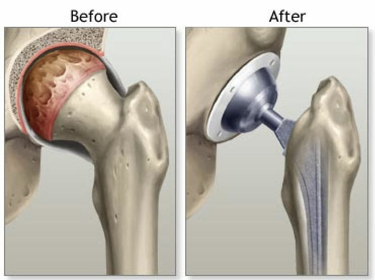 What is Total Hip Replacement Surgical Procedure?