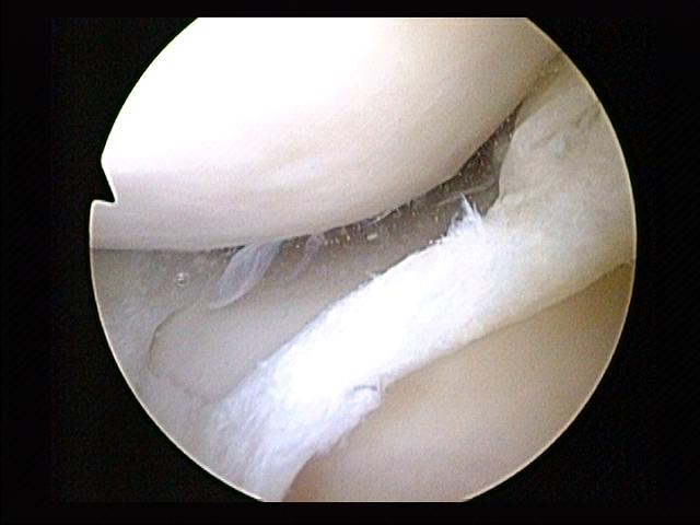 ACL Reconstructed St. George Surgical Center